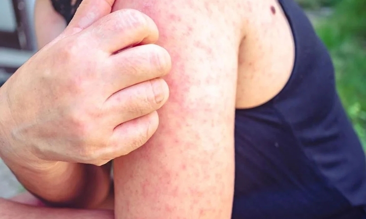 10 thông điệp phòng bệnh sởi của Bộ Y tế