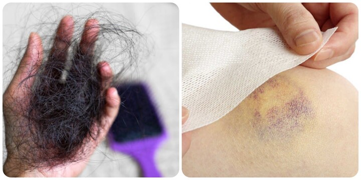 Dấu hiệu cảnh báo cơ thể thiếu vitamin