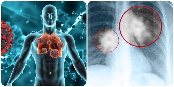 8 dấu hiệu cảnh báo ung thư phổi không nên bỏ qua