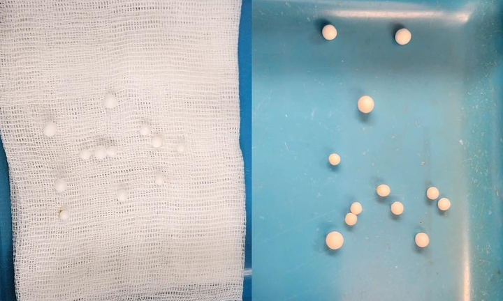 Bé 3 tuổi nhập viện vì mũi đầy dị vật, bác sĩ gắp ra vật bất ngờ