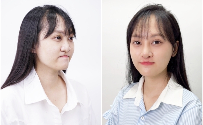 Cô gái 'lột xác' sau hai cuộc đại phẫu kỳ diệu