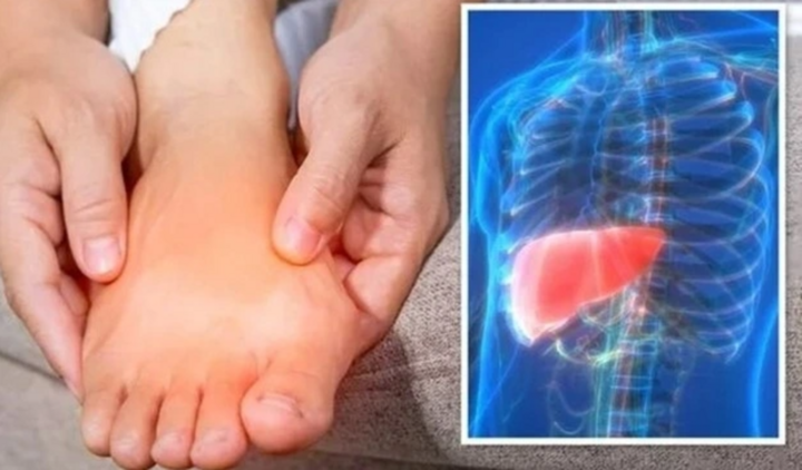 5 dấu hiệu cảnh báo xơ gan thường xuất hiện ở chân 