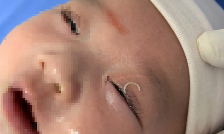 Mẹ cắt móng tay văng vào mắt con 2 tháng tuổi gây viêm sưng