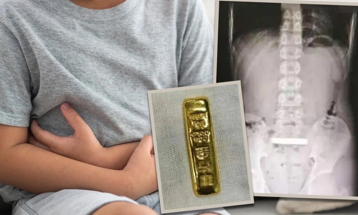 Thỏi vàng nặng 100gr bị cậu bé nuốt vào bụng, phải phẫu thuật để lấy ra