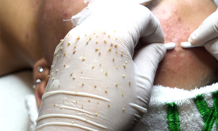 Chuyên gia lý giải vì sao những clip nặn mụn đáng sợ thu hút hàng triệu view