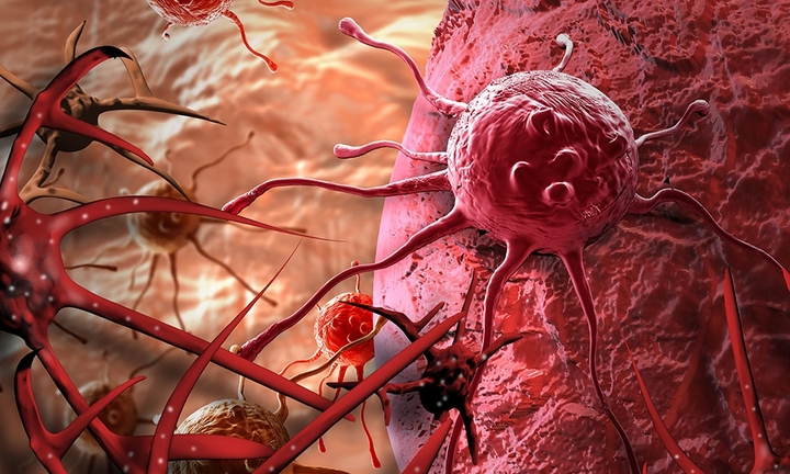 Phát hiện ung thư hiếm gặp xâm lấn bàng quang sau nhiều lần phẫu thuật