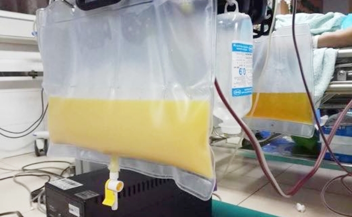 Lý do khiến huyết tương người đàn ông đục như nước gạo