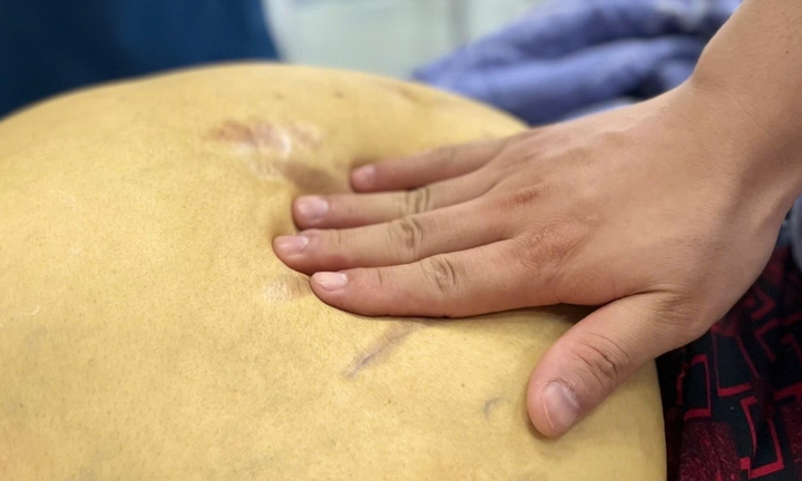 'Nát' gan, đối mặt ung thư vì thói quen nhiều người Việt vô tư làm