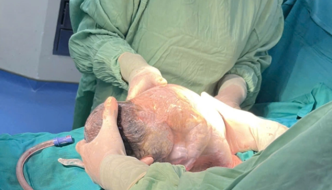 Ca sinh mổ hiếm gặp tỉ lệ chỉ 1/80.000