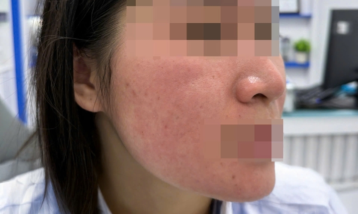 Bỏng da mặt vì dùng chanh tươi trị mụn