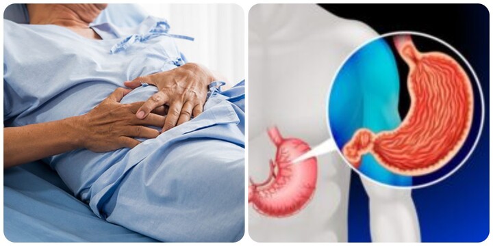 Dấu hiệu ung thư dạ dày giai đoạn cuối