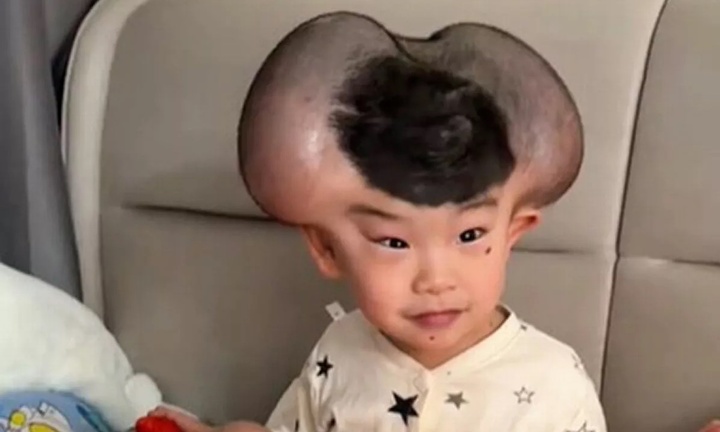 Nốt ruồi khổng lồ phủ kín hộp sọ khiến cậu bé có ngoại hình giống chuột Mickey