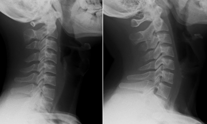 Nam thanh niên cột sống 'thẳng như cây gậy' vì thói quen triệu người mắc