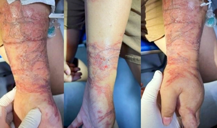 Ôm 'sinh vật lạ' khi chơi ở biển, bé gái phỏng rộp hai tay