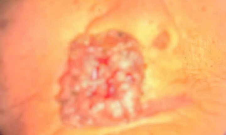 Giòi làm tổ trong khối u trên gương mặt cụ bà 88 tuổi