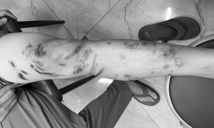 Tổn thương chằng chịt cơ thể do bị sứa chích khi tắm biển