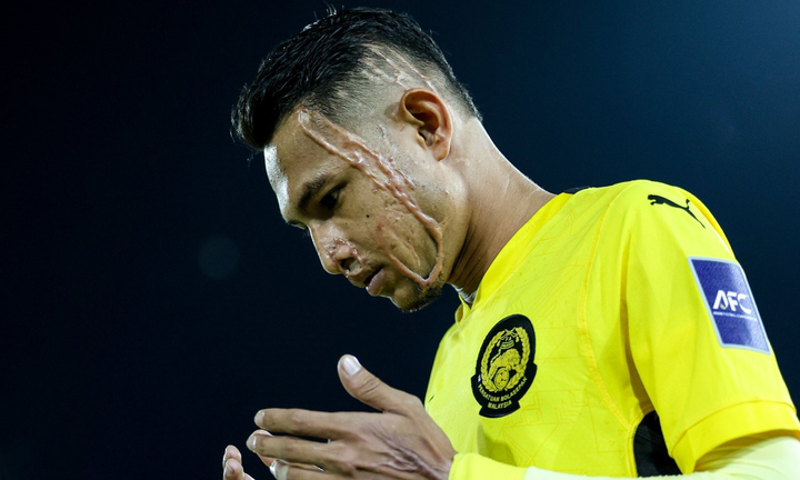 Bi kịch cầu thủ sắp đấu tuyển Việt Nam: Bị tạt axit, không thể cười bình thường