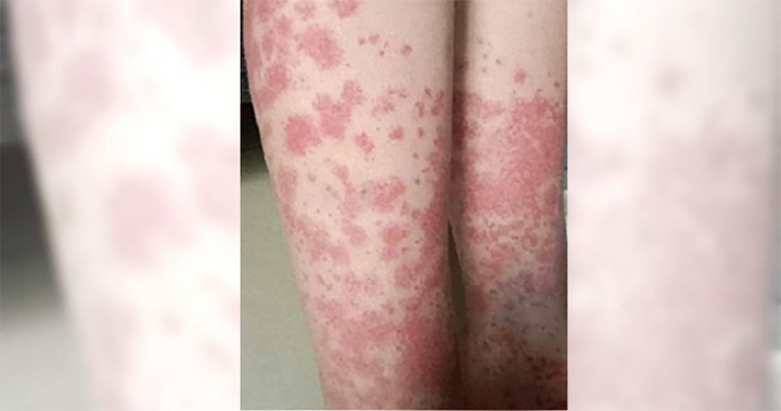 Nữ sinh trả giá đắt vì nhuộm tóc liên tục: Thận chảy máu, phải cạo đầu giữ mạng