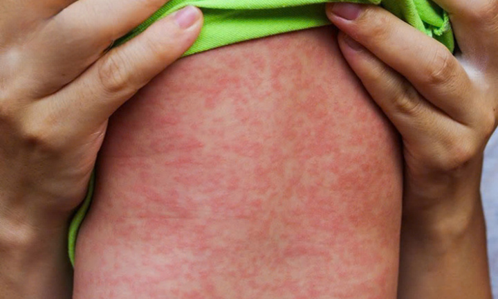 TP.HCM hết dịch sởi 100%