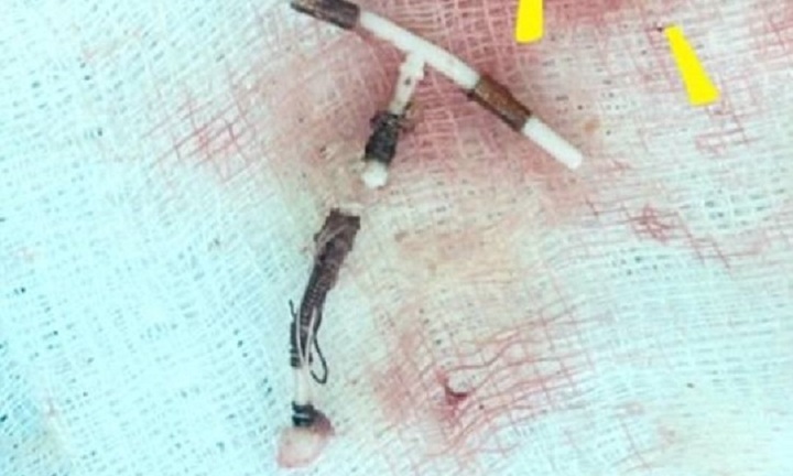 Phát hiện vòng tránh thai 'đi lạc' trong ổ bụng người phụ nữ hơn 10 năm