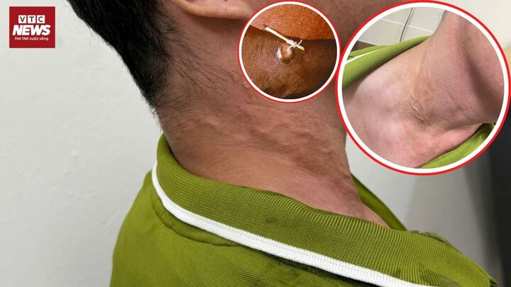 Rùng mình phát hiện giun rồng dài 70cm trong chân, ca bệnh thứ 27 ở Việt Nam