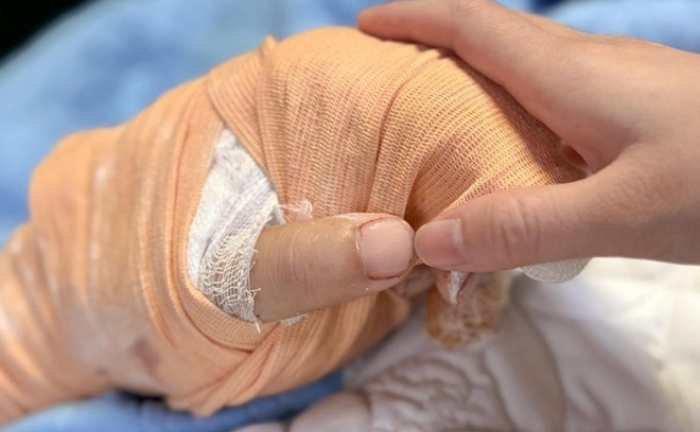 Truyền 2,5 lít máu nối bàn tay bị chém gần đứt cho nam thanh niên ở Thái Nguyên