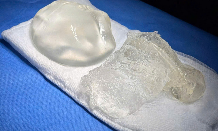 Tháo túi ngực, mê mask thanh quản