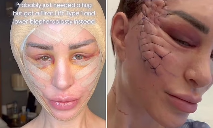 Mốt căng da mặt như dị nhân đang 'làm mưa làm gió' khiến nhiều người rùng mình