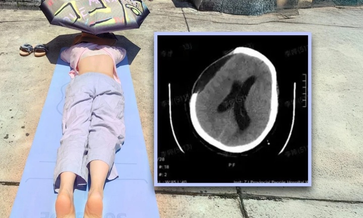 Tắm nắng cho khỏe, người phụ nữ bị xuất huyết não, hôn mê