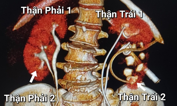 Người phụ nữ phát hiện có 4 quả thận