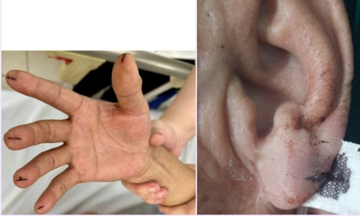 Chích máu đầu ngón tay cứu đột quỵ: Cứu người hay rước họa?