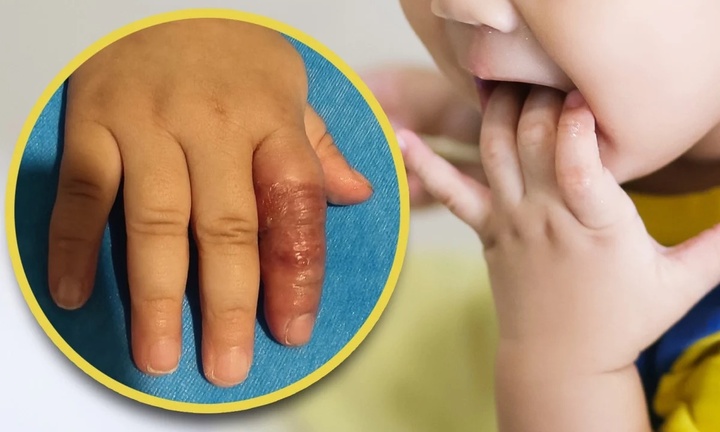 Mẹ dùng băng quấn để ngăn con mút tay, em bé suýt phải cắt cụt ngón 