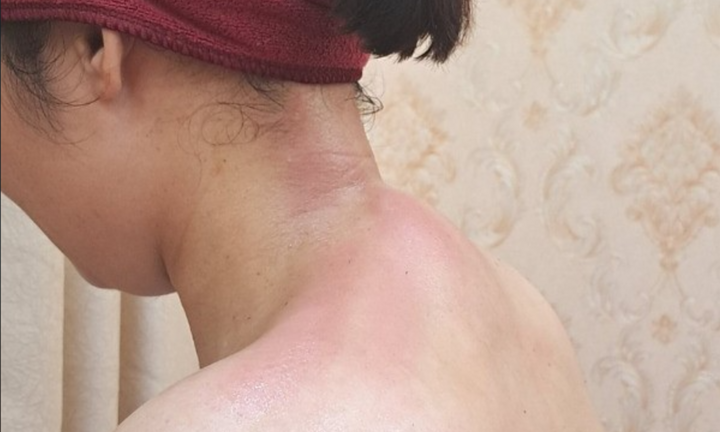 Đau vai gáy dai dẳng cảnh báo thoái hóa đốt sống cổ từ thói quen xấu