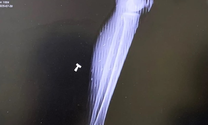 Sở thích ăn uống khiến người đàn ông 'nuôi' ổ sán trong cơ thể