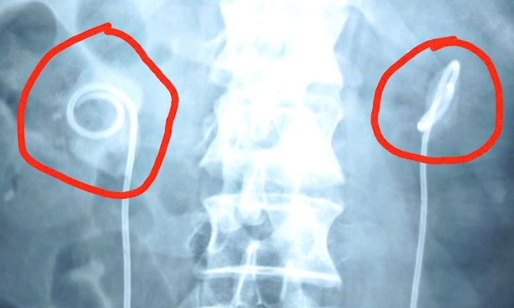 Suýt chết vì quên ống thông niệu quản trong cơ thể suốt 2 năm