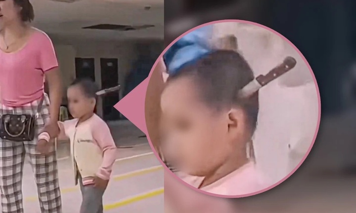 Bác sỹ kinh hãi khi bé gái 3 tuổi được mẹ dắt vào viện với con dao cắm vào đầu