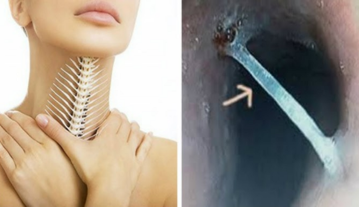 Mẹo chữa hóc xương cá bằng cách súc miệng