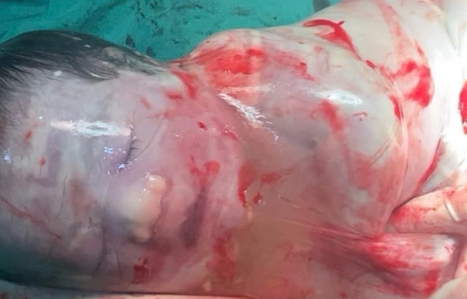 Kỳ diệu bé trai sinh ra trong 'bọc điều' ở Hà Nội, chỉ xuất hiện 1/80.000 ca