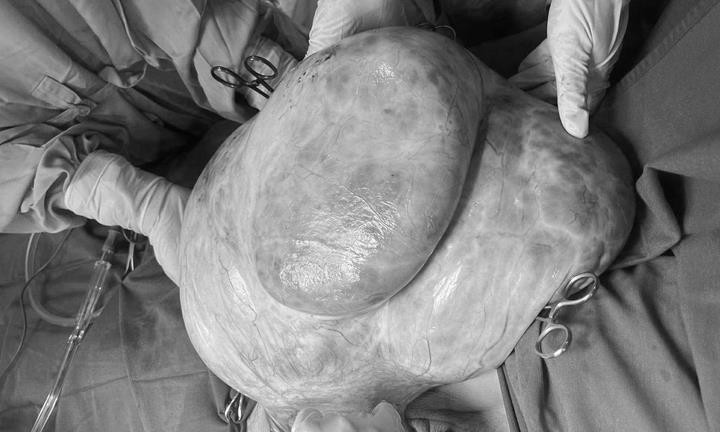 Bụng to tưởng béo, người phụ nữ không ngờ mang khối u buồng trứng 15kg