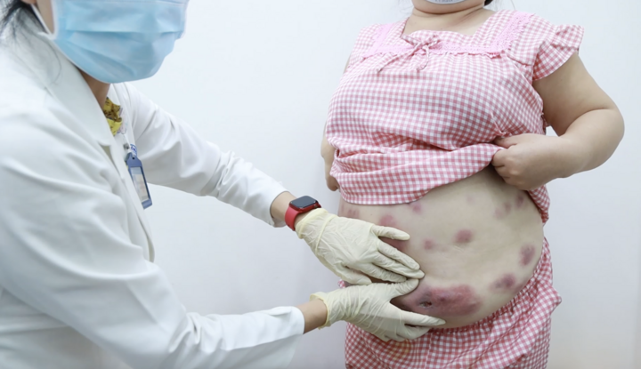 Nhiều phụ nữ gặp biến chứng nặng do tiêm tan mỡ trôi nổi