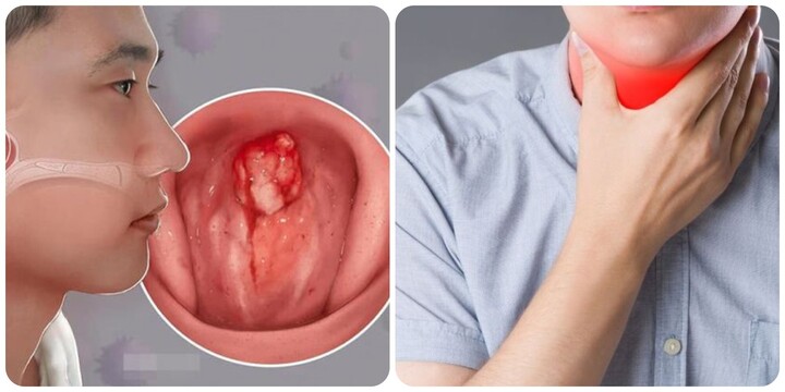9 dấu hiệu ung thư vòm họng giai đoạn đầu