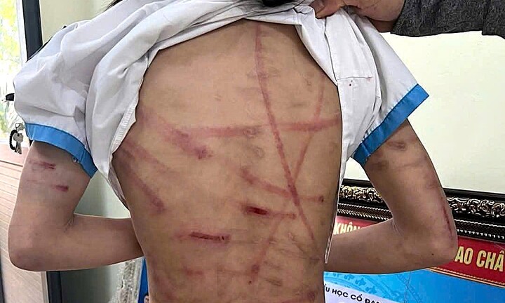 Bé gái lớp 5 ở Hà Tĩnh bị cha dượng bạo hành dã man: Đây không phải lần đầu