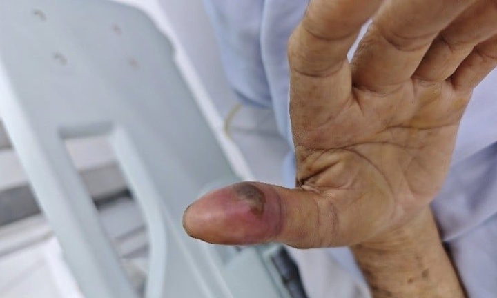 Cứu sống cụ ông ở TP.HCM bị rắn lục đuôi đỏ cắn nguy kịch