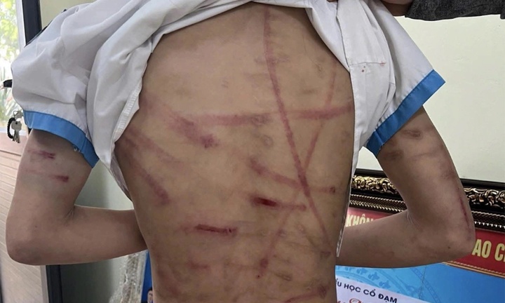 Bé gái 10 tuổi bị cha dượng bạo hành ở Hà Tĩnh được ra viện