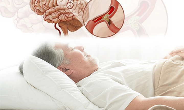 Cảnh báo nguy cơ đột tử do ngủ ngáy kéo dài