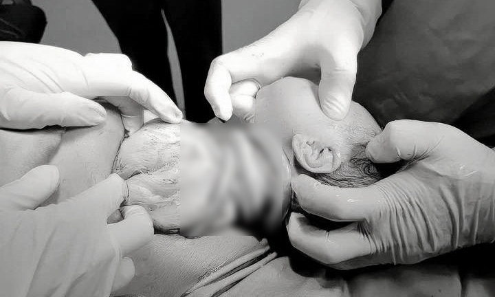 Bé gái chào đời với 6 vòng dây rốn quấn cổ, mẹ tiền sản giật
