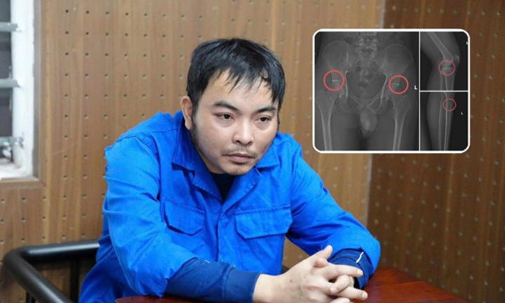 Cựu nhân viên y tế đục vỡ xương trục lợi bảo hiểm: Thủ đoạn tàn nhẫn, bất nhân
