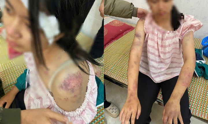 Bé gái bị người nhà đánh đập, tra tấn dã man vì nghi trộm tiền