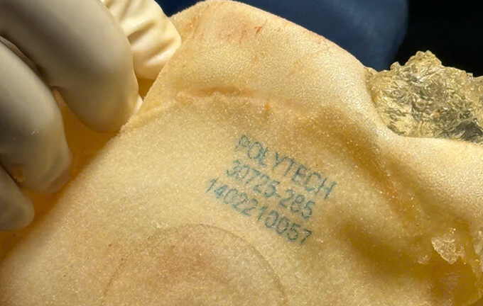 Ưu điểm tháo túi ngực và thay túi ngực, mê mask thanh quản