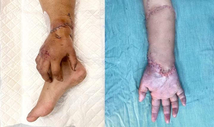 Bàn tay đứt lìa của mẹ bầu được nối lại sau thời gian 'nuôi' ở chân